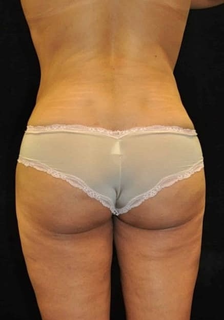 Brazilian Butt Lift Before & After