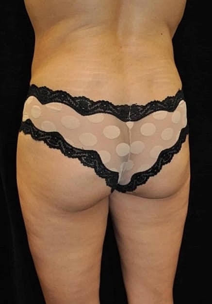 Brazilian Butt Lift Before & After