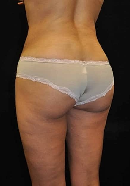 Brazilian Butt Lift Before & After