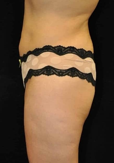 Brazilian Butt Lift Before & After