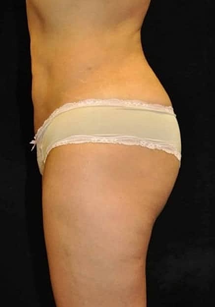 Brazilian Butt Lift Before & After