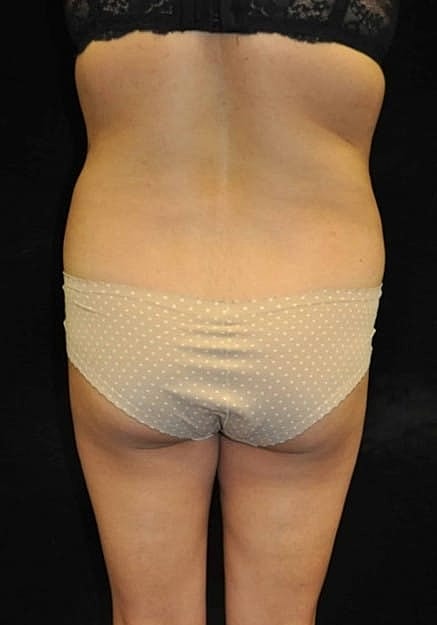 Brazilian Butt Lift Before & After