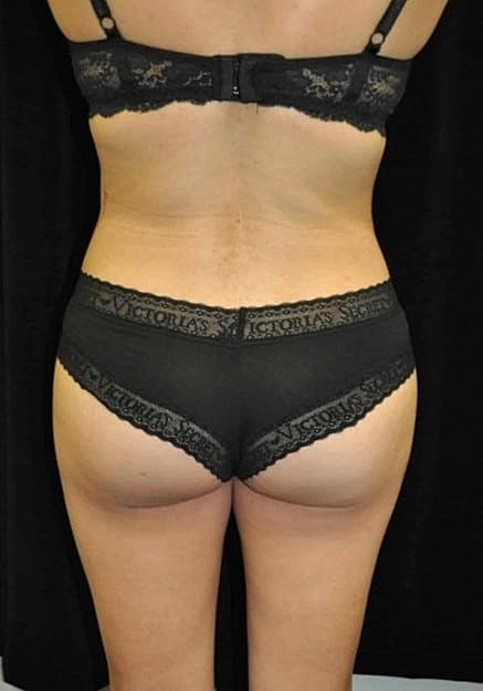 Brazilian Butt Lift Before & After