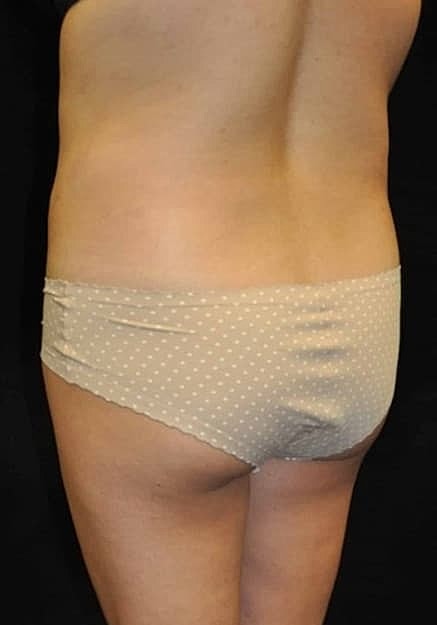 Brazilian Butt Lift Before & After