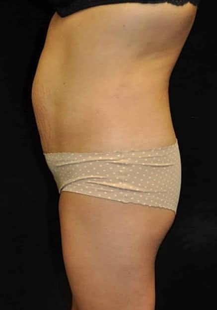 Brazilian Butt Lift Before & After
