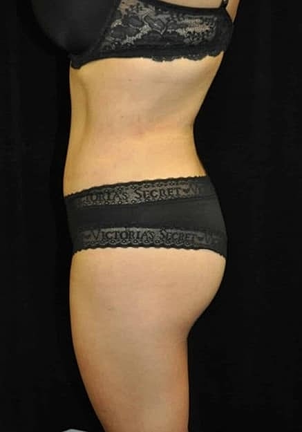 Brazilian Butt Lift Before & After