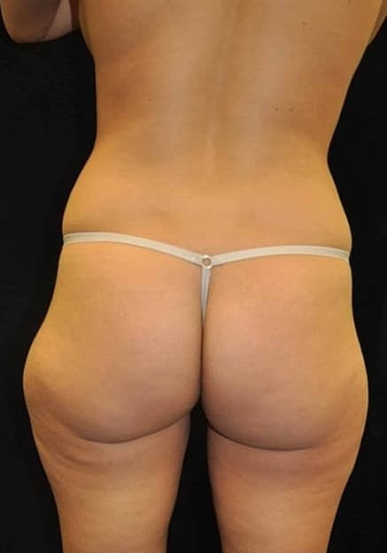 Brazilian Butt Lift Before & After