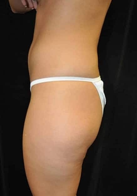 Brazilian Butt Lift Before & After