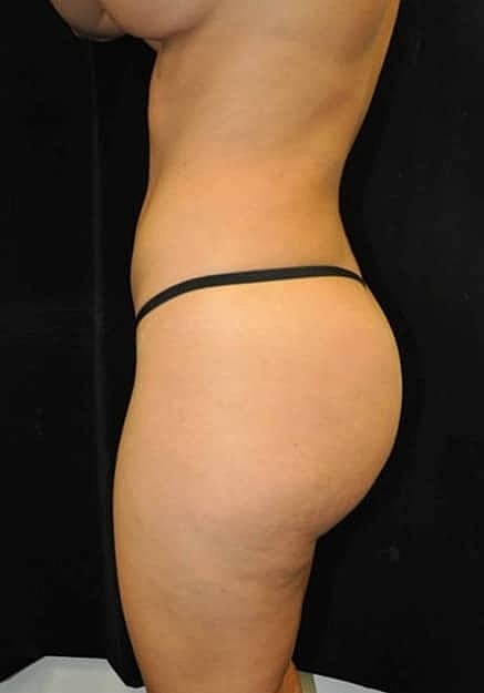 Brazilian Butt Lift Before & After