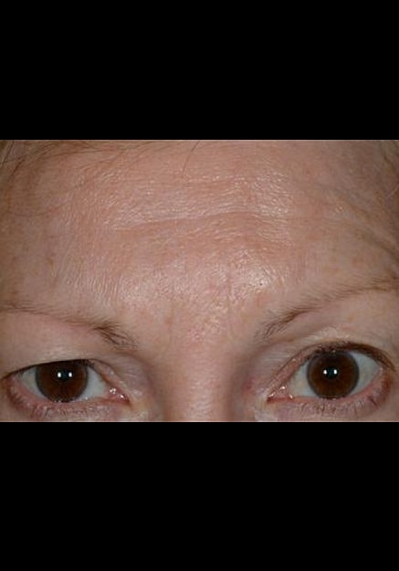 Botox Before & After