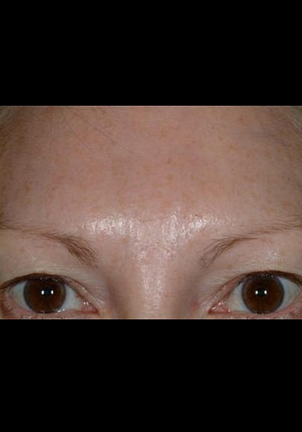 Botox Before & After