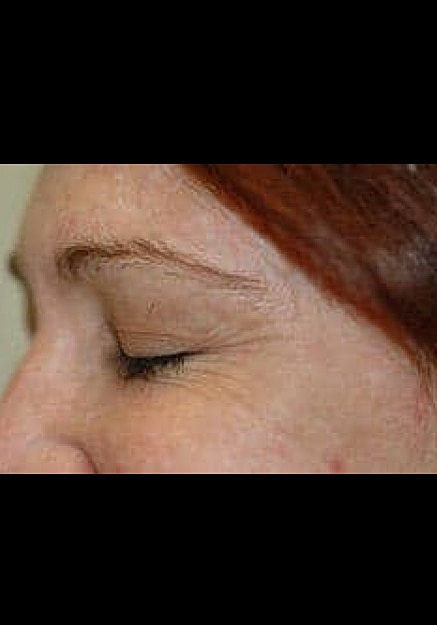 Botox Before & After