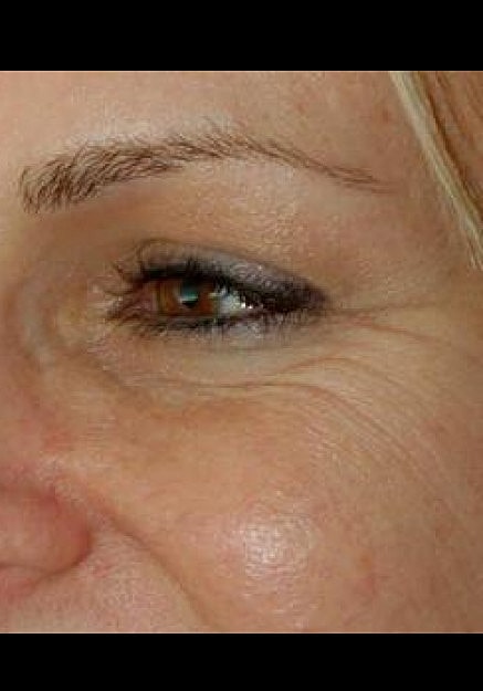 Botox Before & After