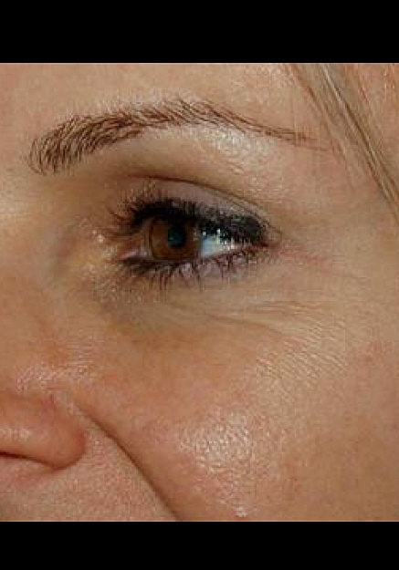Botox Before & After