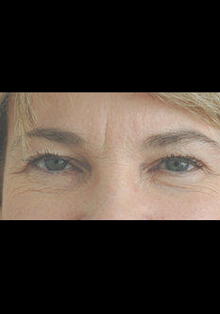 Botox Before & After