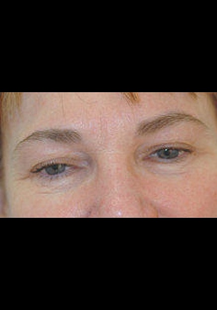 Botox Before & After
