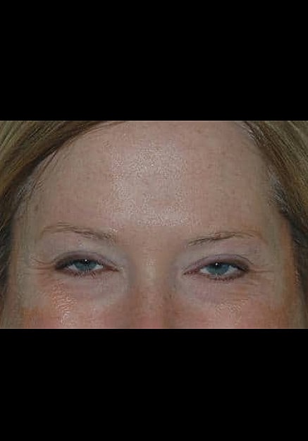 Botox Before & After