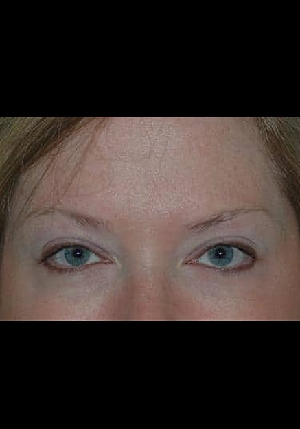 Botox Before & After