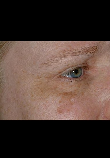 Botox Before & After