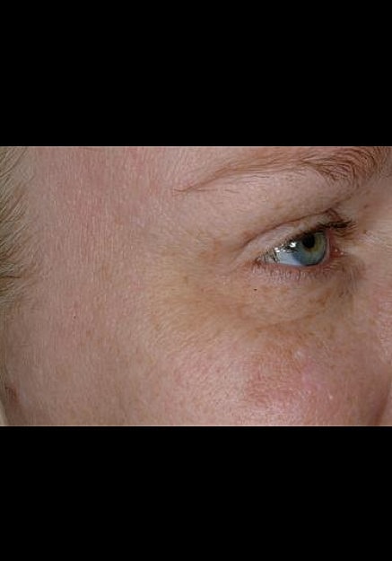 Botox Before & After