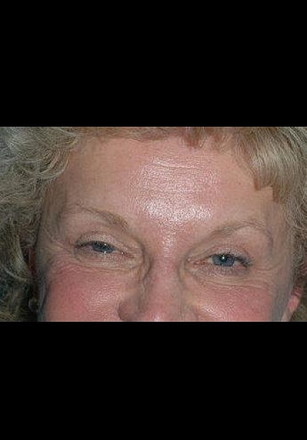 Botox Before & After