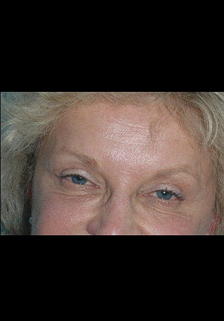 Botox Before & After