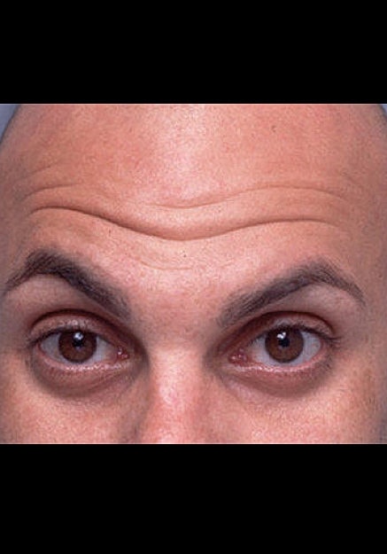 Botox Before & After