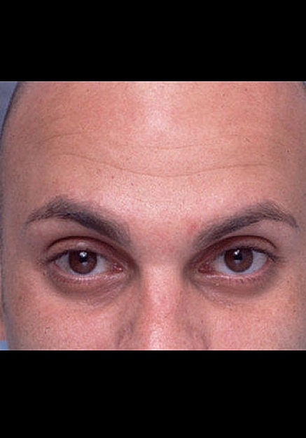 Botox Before & After
