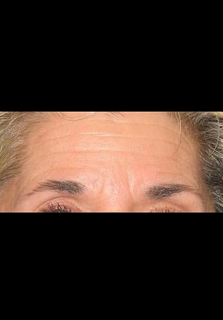 Botox Before & After
