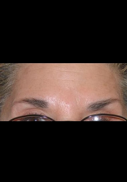 Botox Before & After