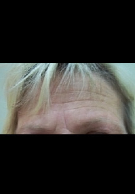 Botox Before & After