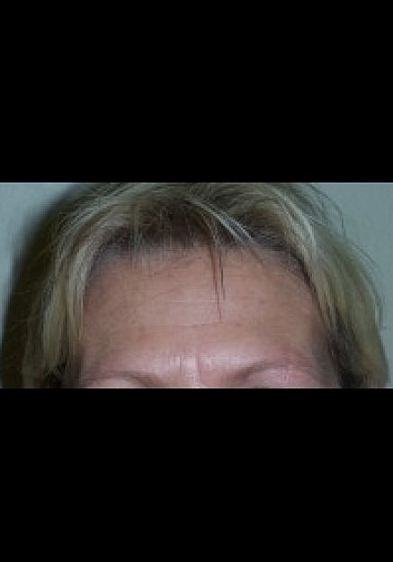 Botox Before & After