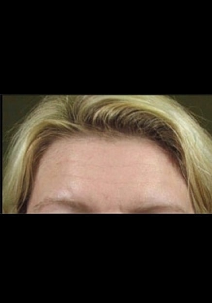 Botox Before & After