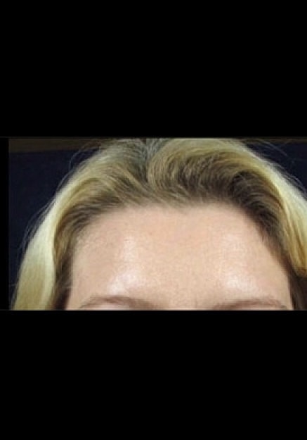 Botox Before & After
