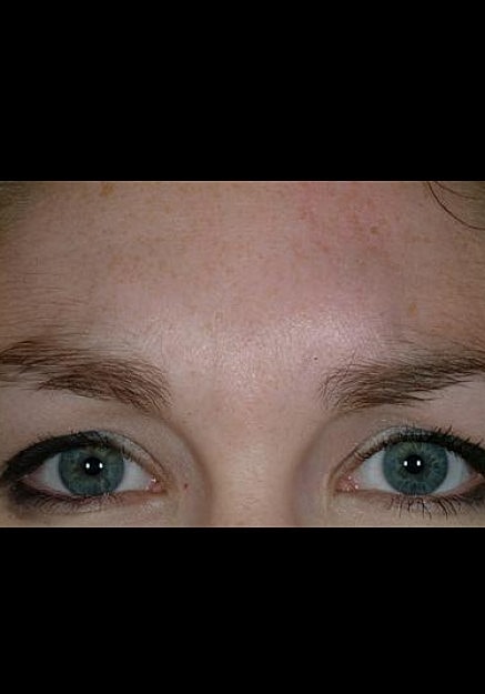 Botox Before & After