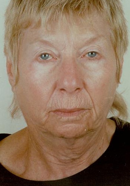 Facelift Before & After