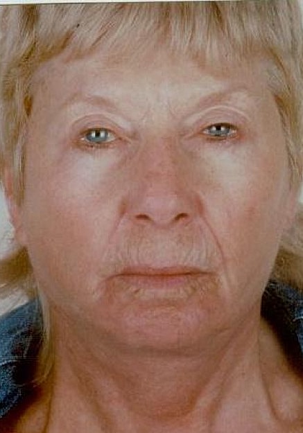 Facelift Before & After