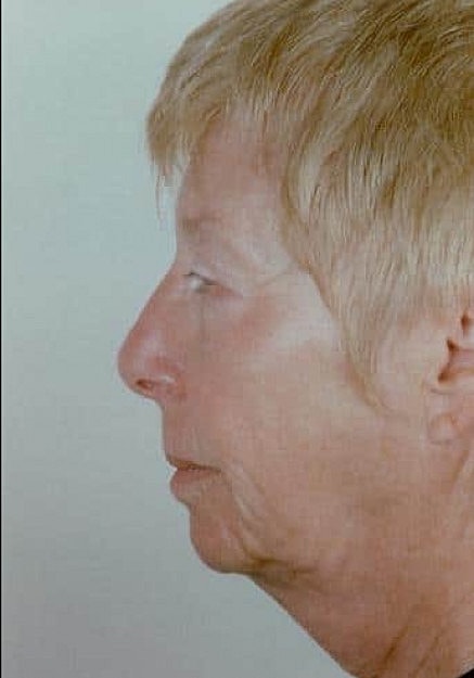 Facelift Before & After