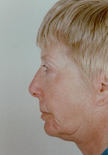 Facelift Before & After