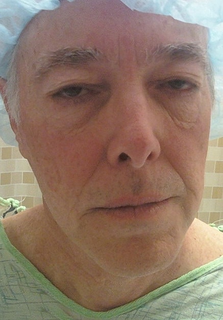 Facelift Before & After