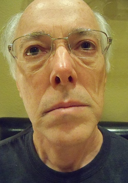 Facelift Before & After
