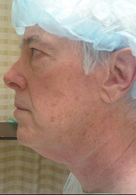 Facelift Before & After