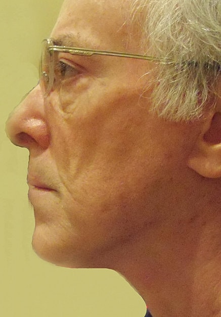Facelift Before & After