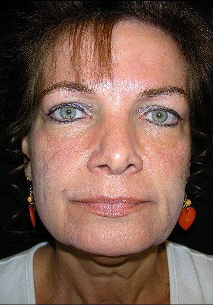 Facelift Before & After