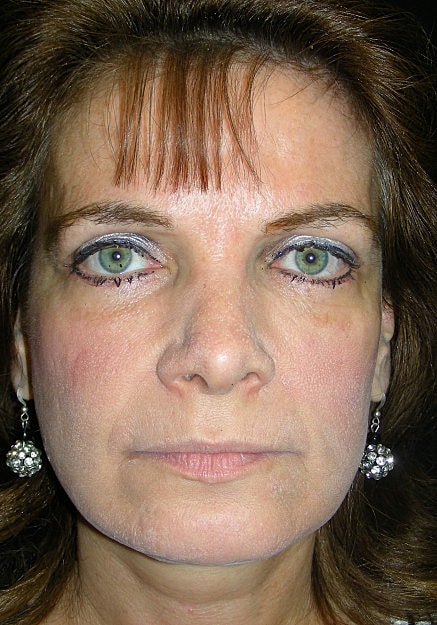 Facelift Before & After