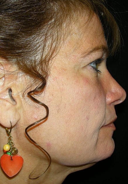 Facelift Before & After