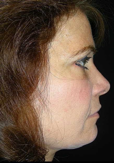 Facelift Before & After