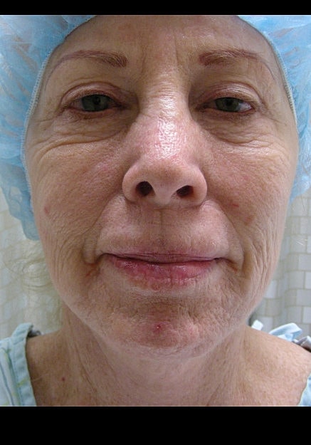 Facelift Before & After