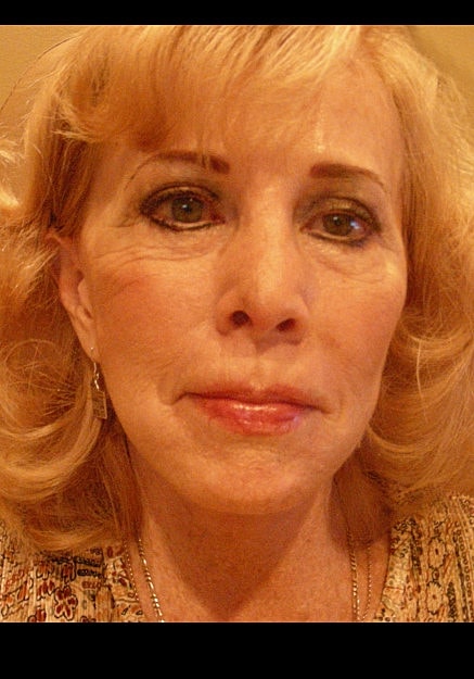 Facelift Before & After