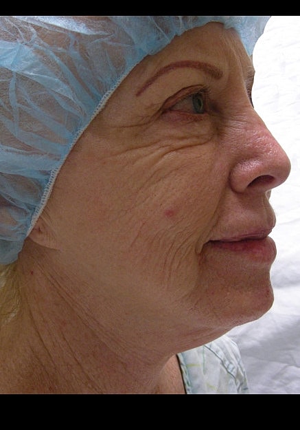 Facelift Before & After